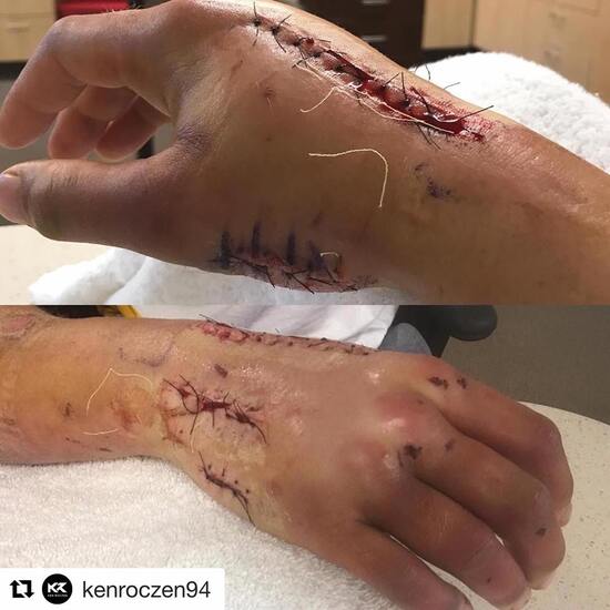 Ken Roczen post operazione