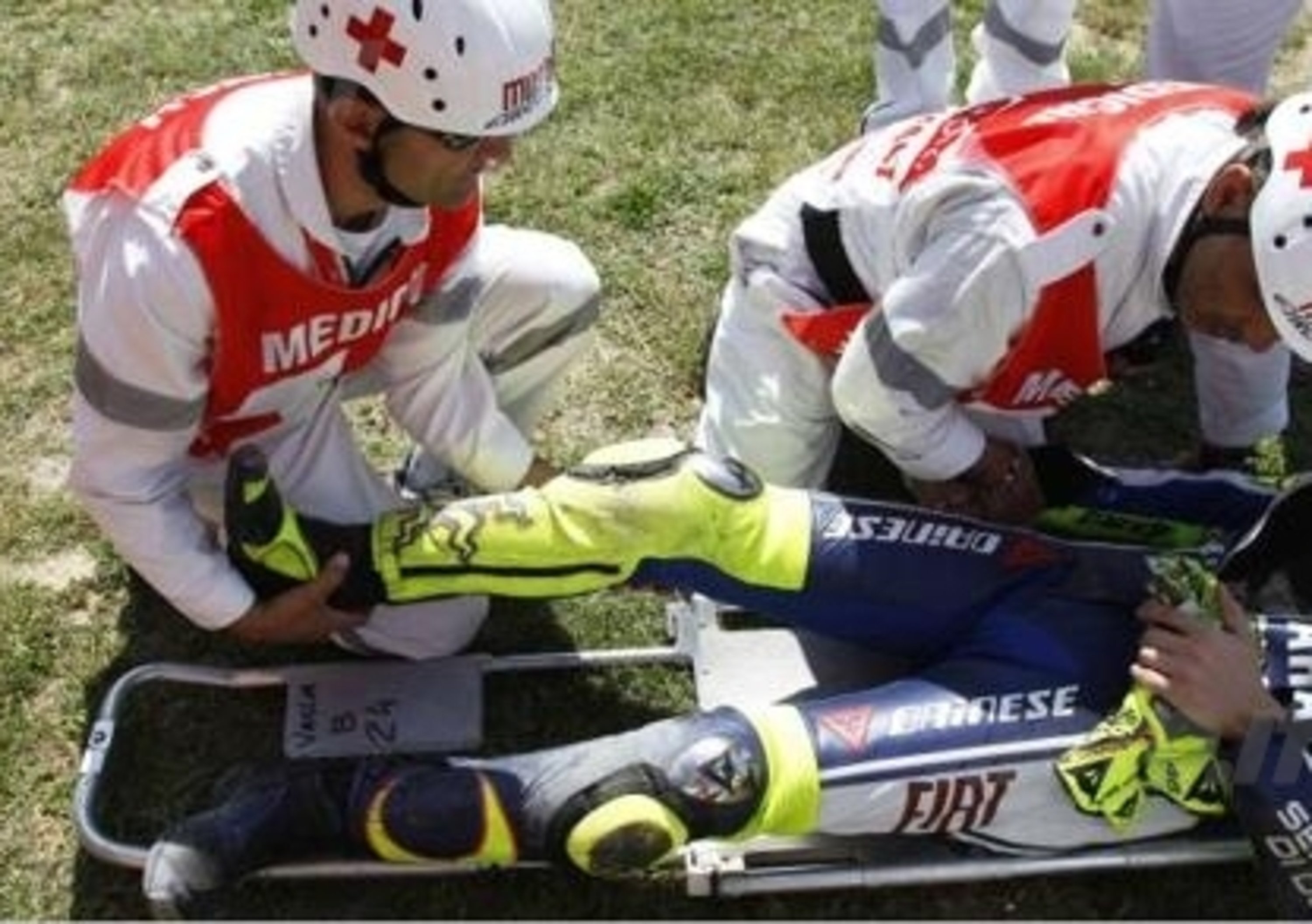 Rossi cade, frattura scomposta ed esposta di tibia e perone