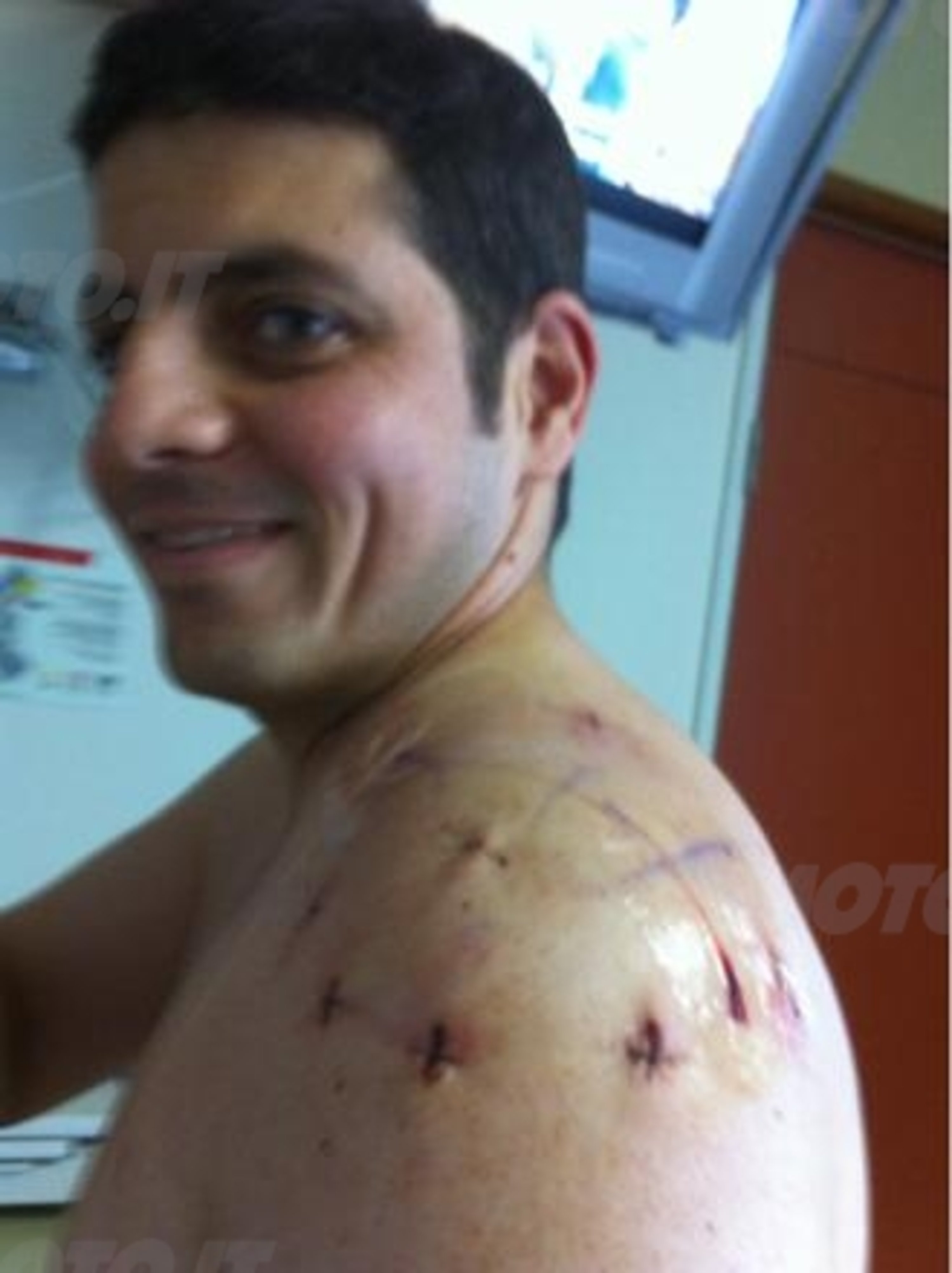 Alex Barros operato alla spalla