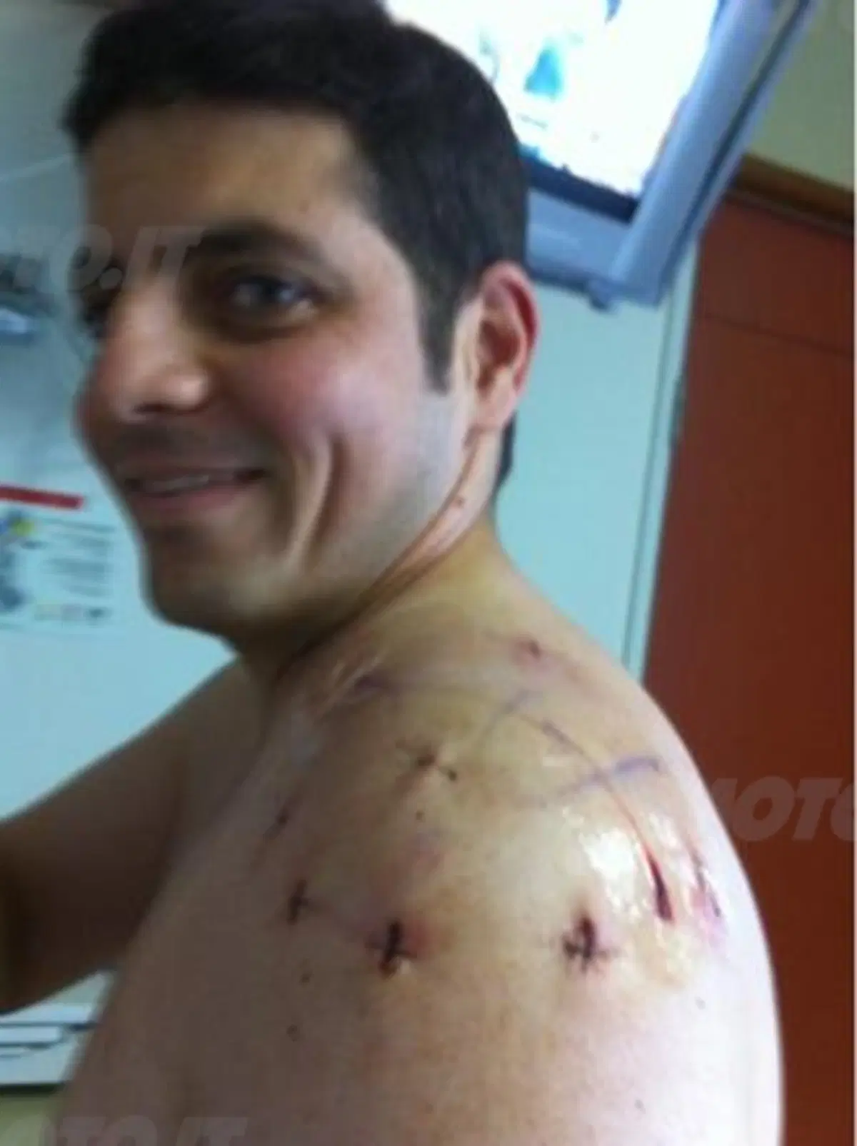 In moto in salute: la lussazione alla spalla (7)