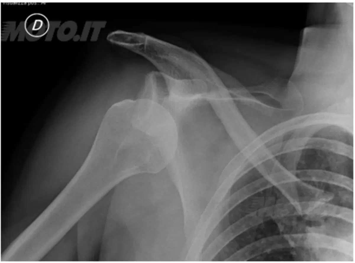 In moto in salute: la lussazione alla spalla (8)
