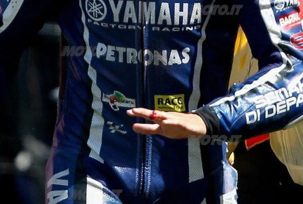 Perfettamente riuscito l'intervento alla mano di Lorenzo