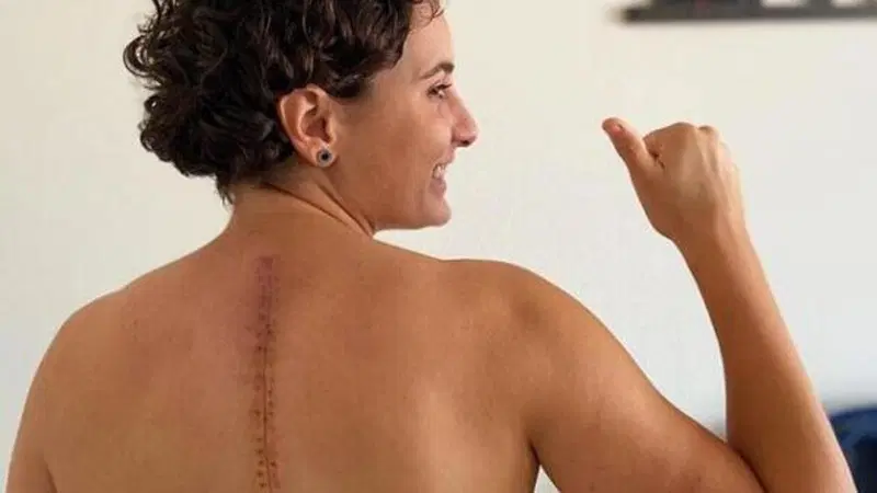 Ana Carrasco condivide la foto della sua cicatrice: "Sempre meglio!"
