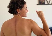 Ana Carrasco condivide la foto della sua cicatrice: Sempre meglio!
