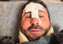 Palermo: cade su una buca e si frattura il naso, incidente per lo chef Natale Giunta