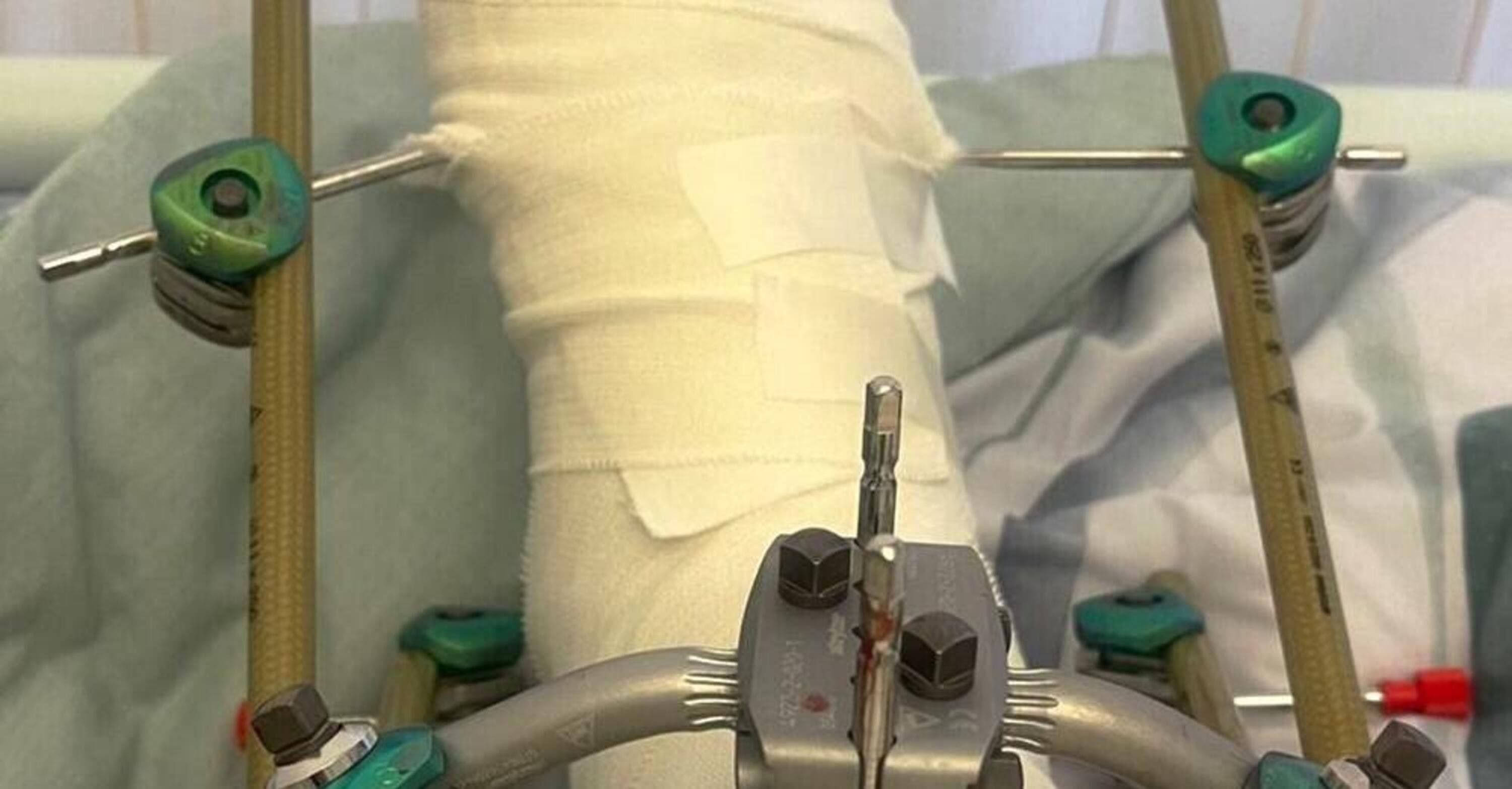 SBK. Michael Van der Mark si frattura una gamba in mountain bike