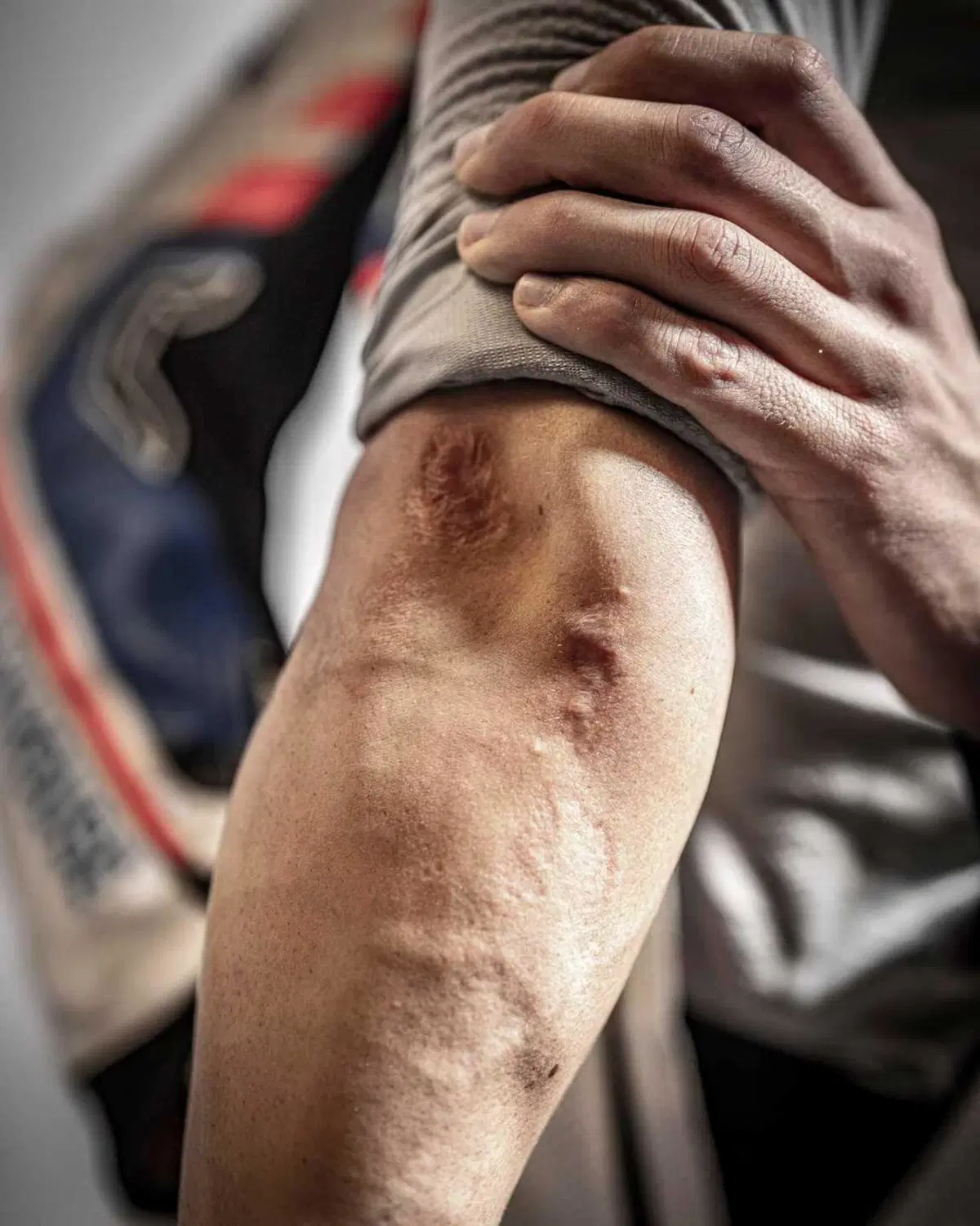 MotoGP 2024. I corpi dei piloti sono pieni di cicatrici: guardate qua! [GALLERY] (13)