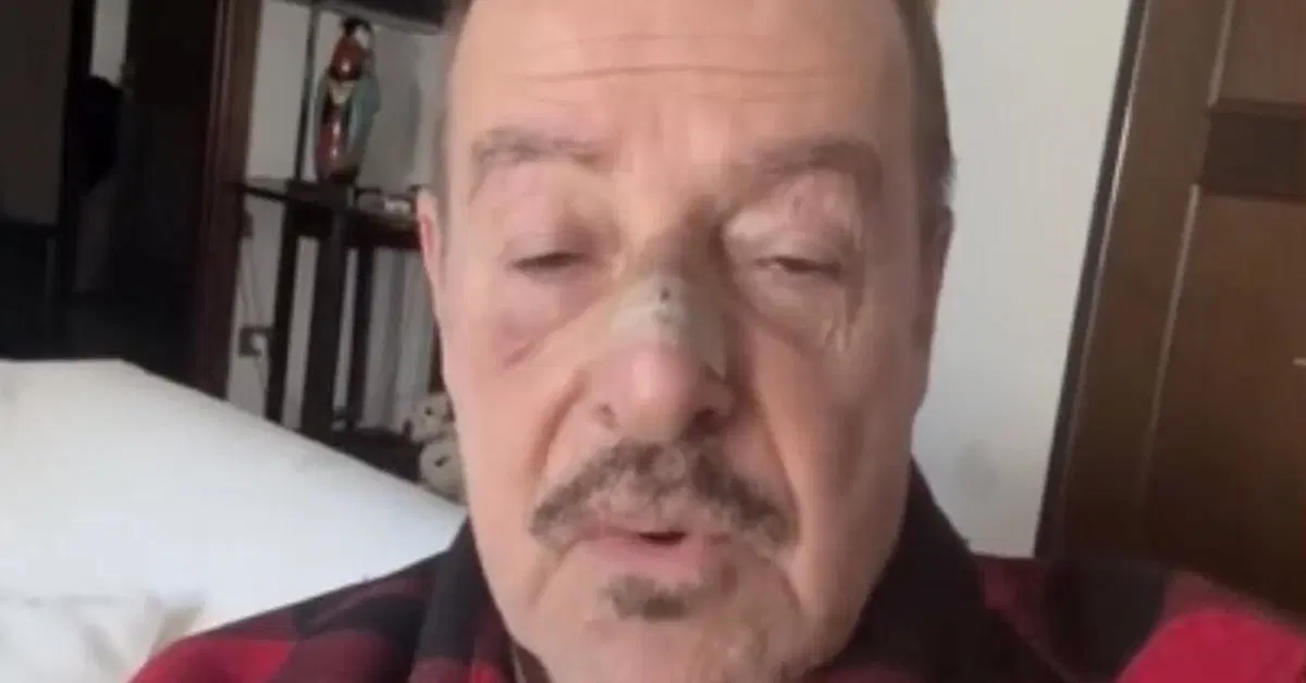 L'attore Massimo Lopez investito da un pirata della strada