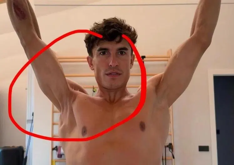Marc Márquez ci ha mostrato com'è messa davvero la sua spalla destra