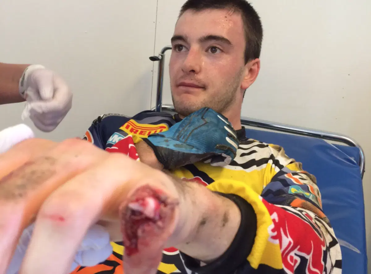 MXGP Svezia 2015. Il dito di Herlings dopo la caduta