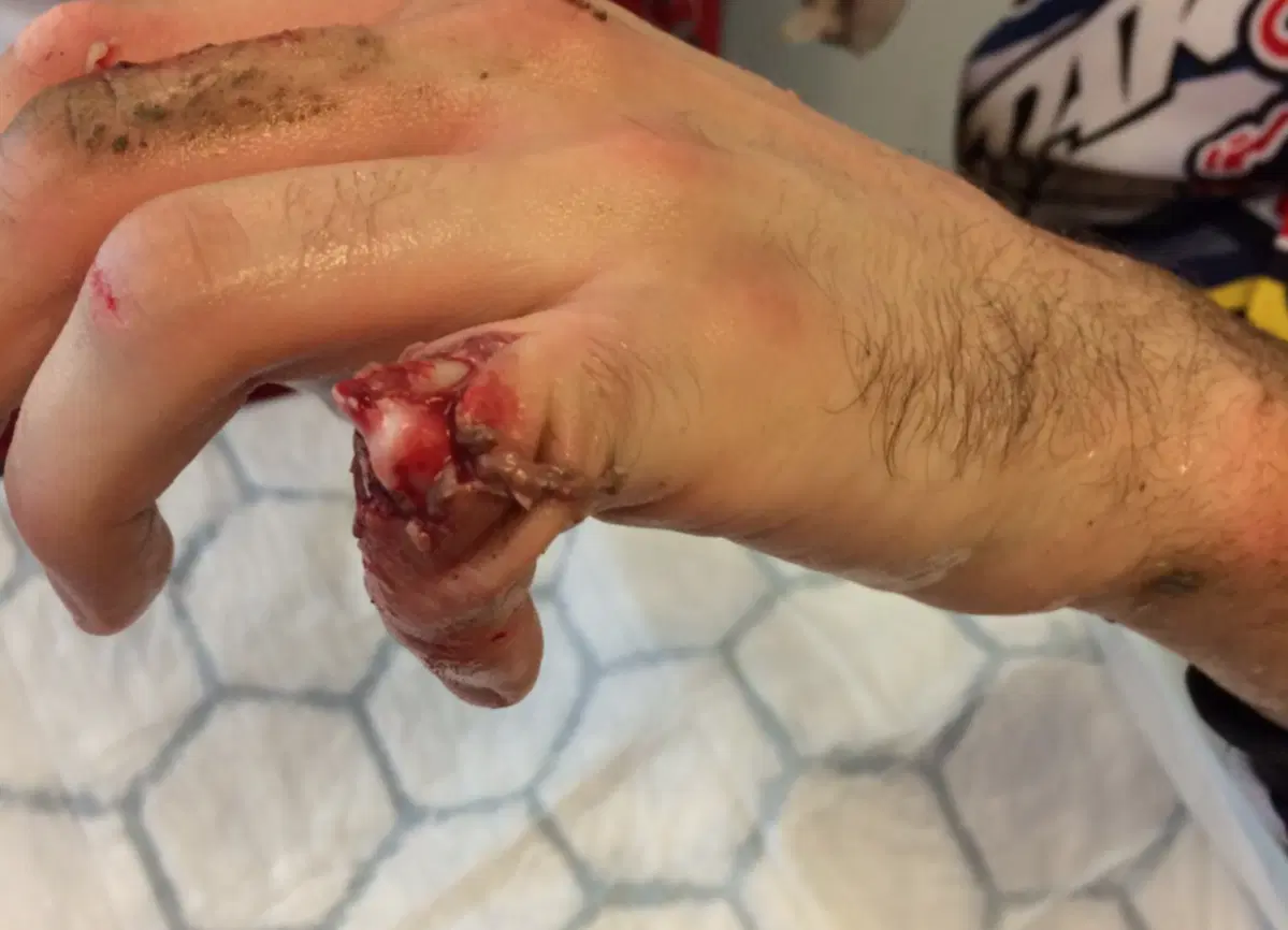 MXGP Svezia 2015. Il dito di Herlings dopo la caduta (2)